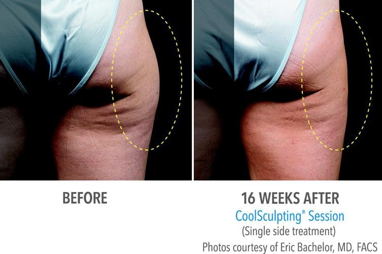 9 Areas of Your Body You Can Reshape with CoolSculpting® - Skin