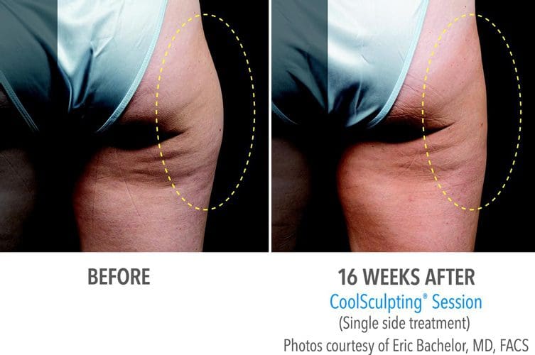 RESIZE YOUR THIGHS WITH COOLSCULPTING The Refinery Skin Clinic