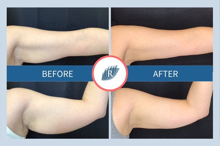 BARE YOUR ARMS CONFIDENTLY WITH COOLSCULPTING The Refinery Skin Clinic