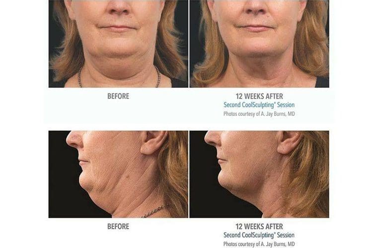 Reduce Double Chin Fat With CoolSculpting