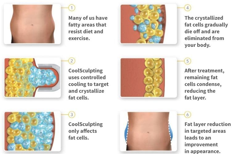 CoolSculpting ® - Freeze Away Fat!