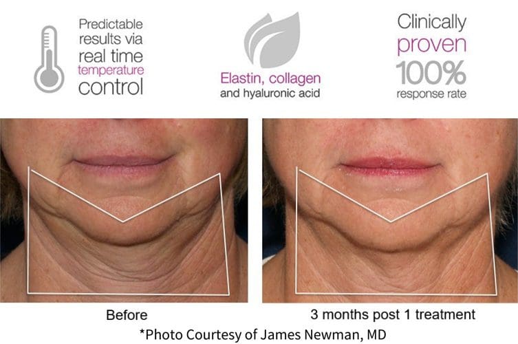 Before and After Photos with Profound RF Microneedling