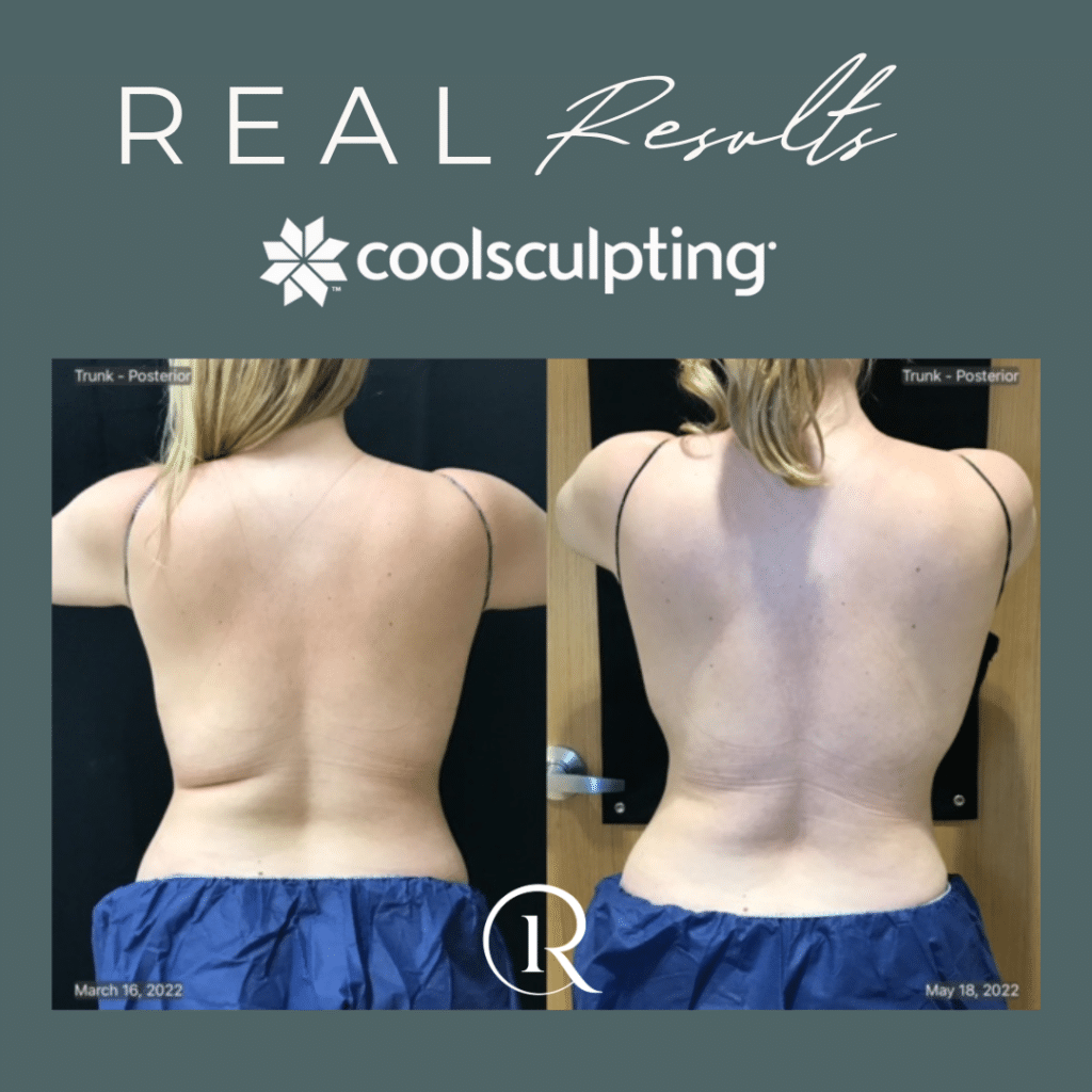 4 Reasons Why CoolSculpting® ELITE is Better than CoolSculpting® - The  Refinery Skin Clinic